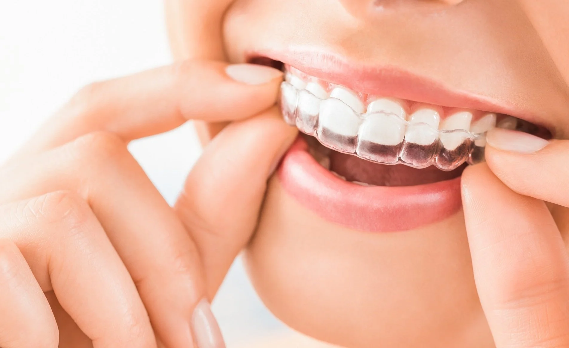 Person removing a clear dental aligner from the upper teeth