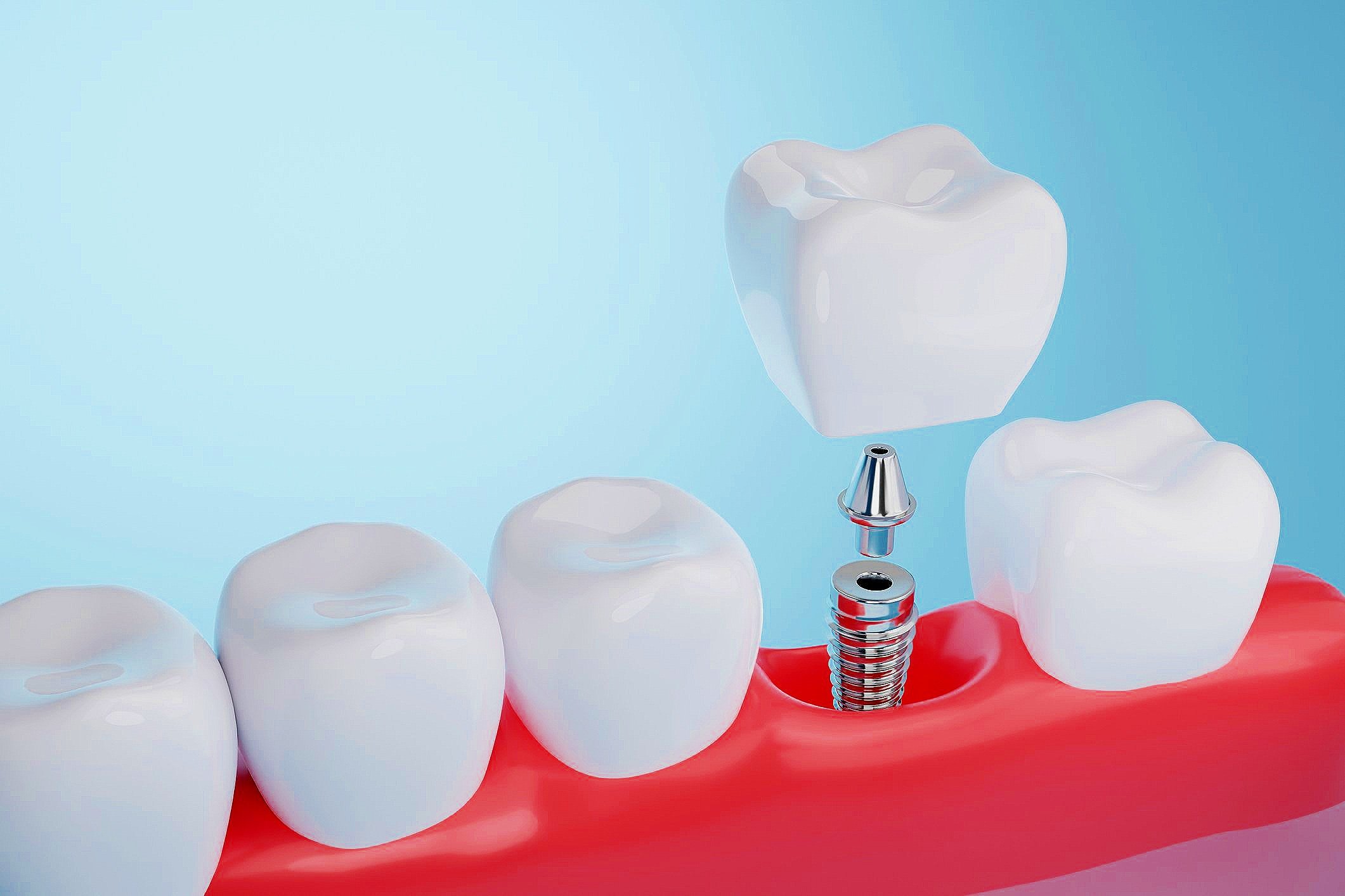 Illustration of a dental implant, abutment, and crown replacing a missing tooth