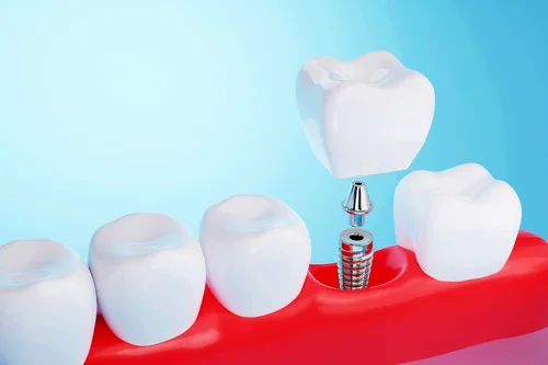 Illustration of a dental implant, abutment, and crown replacing a missing tooth